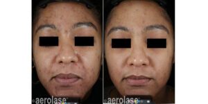 NeoClear Acne - 5 Months After 3 Treatments - David Goldberg MD
