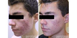 NeoClear Acne - After 4 Treatments - Kevin Pinski MD