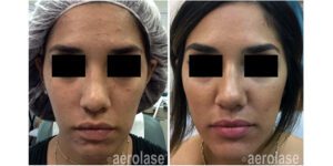 NeoClear Acne - After 4 Treatments - Mark Nestor MD