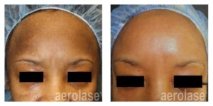 NeoSkin Melasma - After 1 Treatment combined with Glycolic Peel - Cheryl Burgess MD