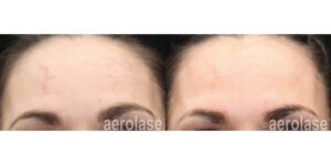 NeoSkin Melasma - After 1 Treatment combined with Salicylic Peel - Suneel Chilukuri MD