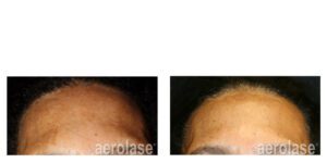 NeoSkin Melasma - After 1 Treatment combined with TCA Peel - Cheryl Burgess MD