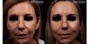 NeoSkin Rejuvenation - After 2 Treatments combined with threads and filler - One Aesthetics