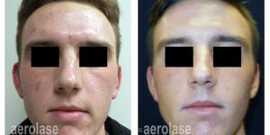 NeoSkin Rejuvenation - After 3 Treatments - Kevin Pinski MD