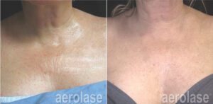 NeoSkin Rejuvenation - After 4 Treatments - Jason Emer MD