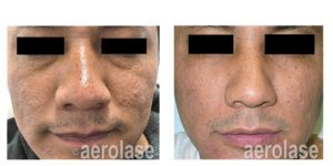 NeoSkin Rejuvenation - After 7 Treatments - Fran Cook-Bolden MD