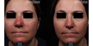 NeoSkin Rosacea - 1 Week After 1 Treatment - One Aesthetics