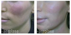 NeoSkin Rosacea - After 1 Treatment - Kevin Pinski MD