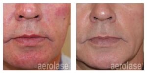 NeoSkin Rosacea - After 2 Treatments - Natalia Geraskova MD