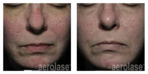 NeoSkin Rosacea and Veins - After 2 Treatments - David Goldberg MD